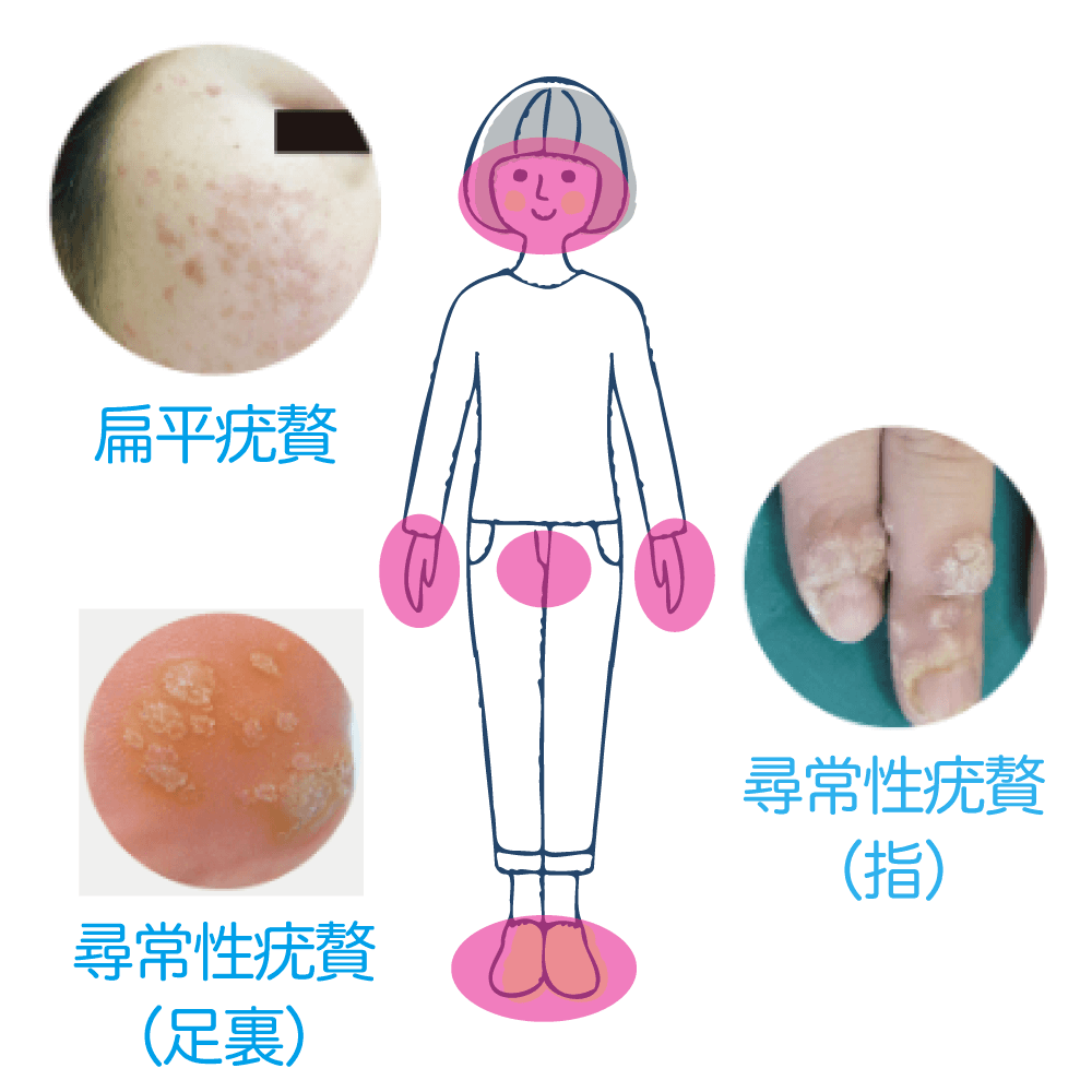 ウイルス性疣贅（イボ） - 自由が丘・奥沢の皮膚科・美容皮膚科【M