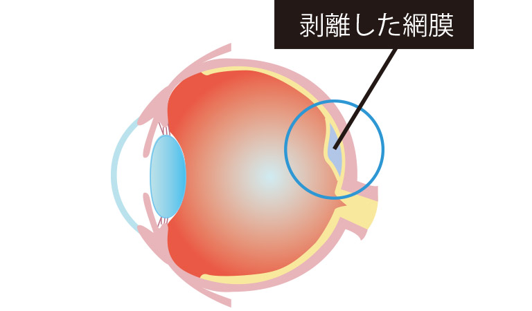 南葛金町眼科│葛飾区│網膜剥離の治療（レーザー・日帰り手術）