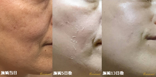 ハーバルピール 注意事項 Q&A | Becarnet ~ ビカルネ.~