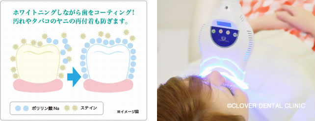 ホワイトニング | 登戸クローバー歯科・矯正歯科 川崎市多摩区の歯医者