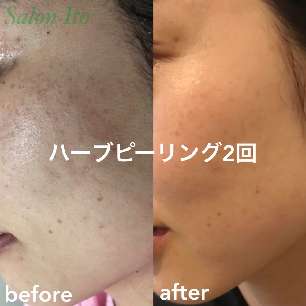 確実に効果を実感☆リベルハーブピーリング | Salon Itoのニュース