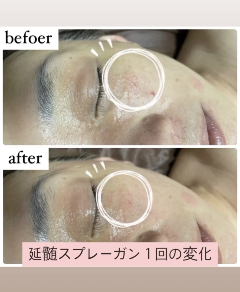 REVI《延髄》人神経幹細胞培養上精液】 | Salon du ひゃーく 志木駅前