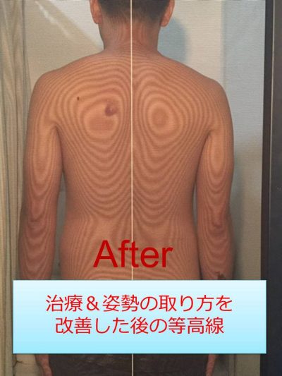 モアレグラフィー検査で身体の歪みをチェック｜J-CLINIC 理学療法科