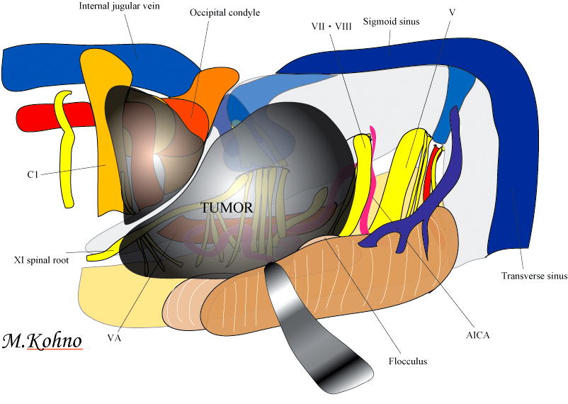 頭蓋底髄膜腫の手術
