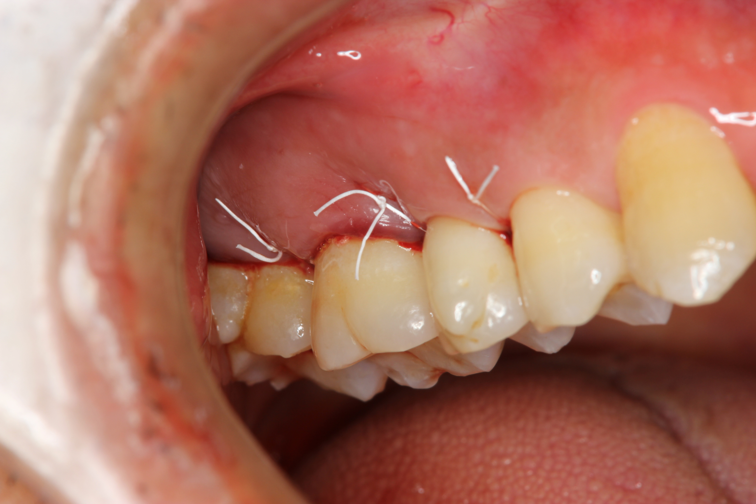 重度歯周病の治療 ～再生療法～ | 歯周病専門外来 たけのうち歯科