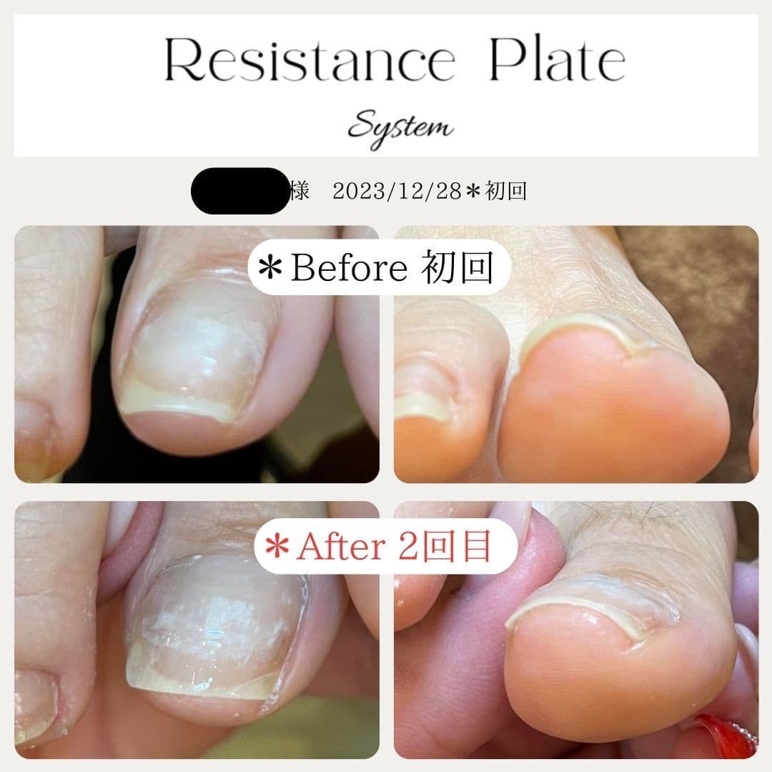 レジスタンスプレート【巻き爪解放】申込フォーム of TOKYO NAIL+COLLEGE