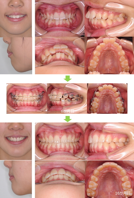 治療の進め方 - アポロ矯正歯科