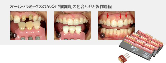 審美歯科 ｜和泉市 信太山の歯医者 井上歯科医院