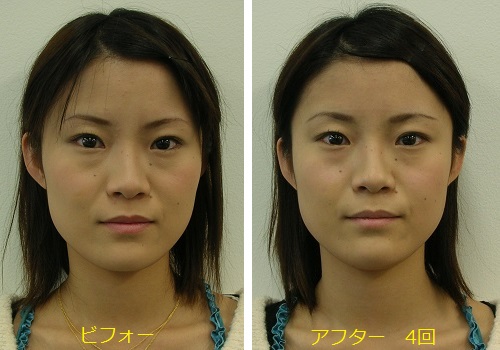 小顔矯正|顎エラ頬鼻筋の非対称顔歪み専門|関西プロポーション小顔