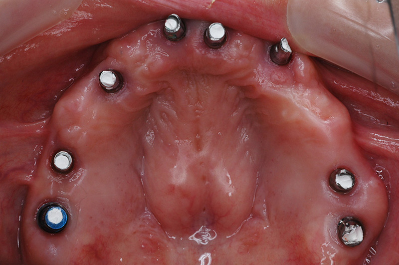 宮井歯科医院| Case.3：8本のインプラントとオールセラミック治療