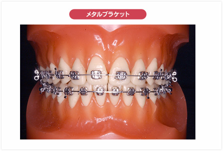 矯正治療について｜根津矯正歯科クリニック