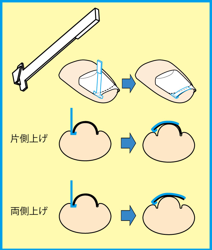 PFS使用方法/巻き爪補正（ペディグラス）