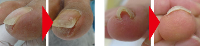 PFS使用方法/巻き爪補正（ペディグラス）