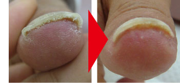 WFS使用方法/巻き爪補正（ペディグラス）