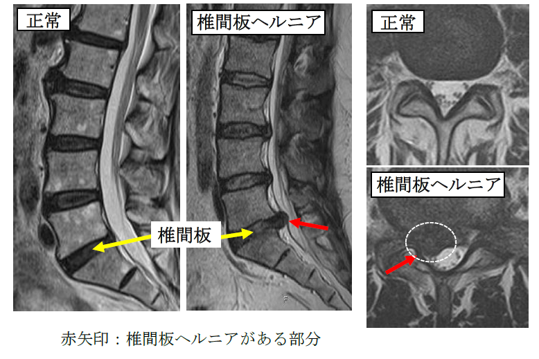 脊椎脊髄疾患について｜東京脊椎脊髄病センター