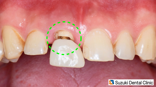 9/25 バイクで事故って前歯やっちゃいました（インプラント） | ブルー