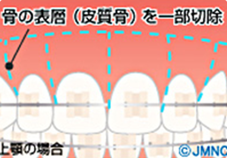 矯正治療の期間短縮化を図る方法 - くにい歯科・矯正歯科｜栃木宇都宮