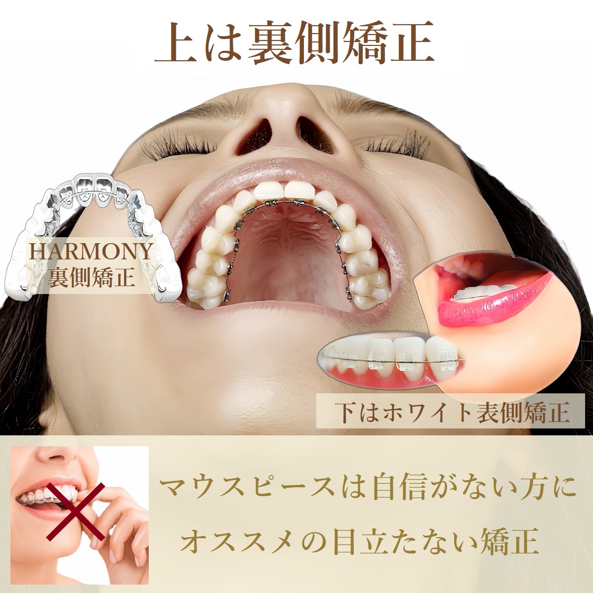 TBDCハーフリンガル矯正