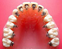 リンガルブラケット矯正装置の種類｜矯正歯科専門医院なら渋谷にある