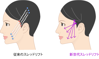 糸リフト（新世代スレッドリフト）によるほうれい線治療 | セオリー