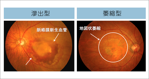 西宮市｜とみい眼科クリニック夙川-加齢性黄斑変性症