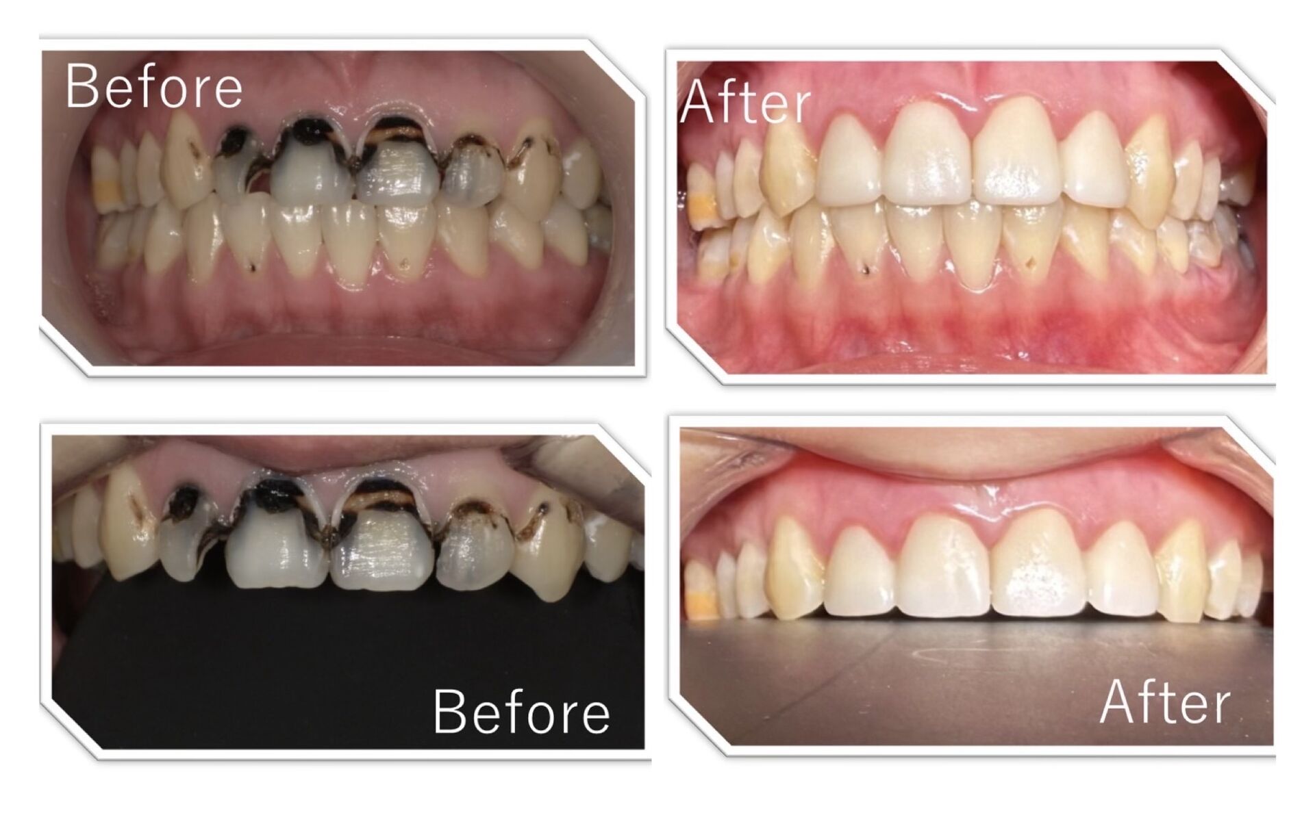 前歯部の重度虫歯を、当日で審美修復したケース🦷✨ | 症例一覧 | 東京