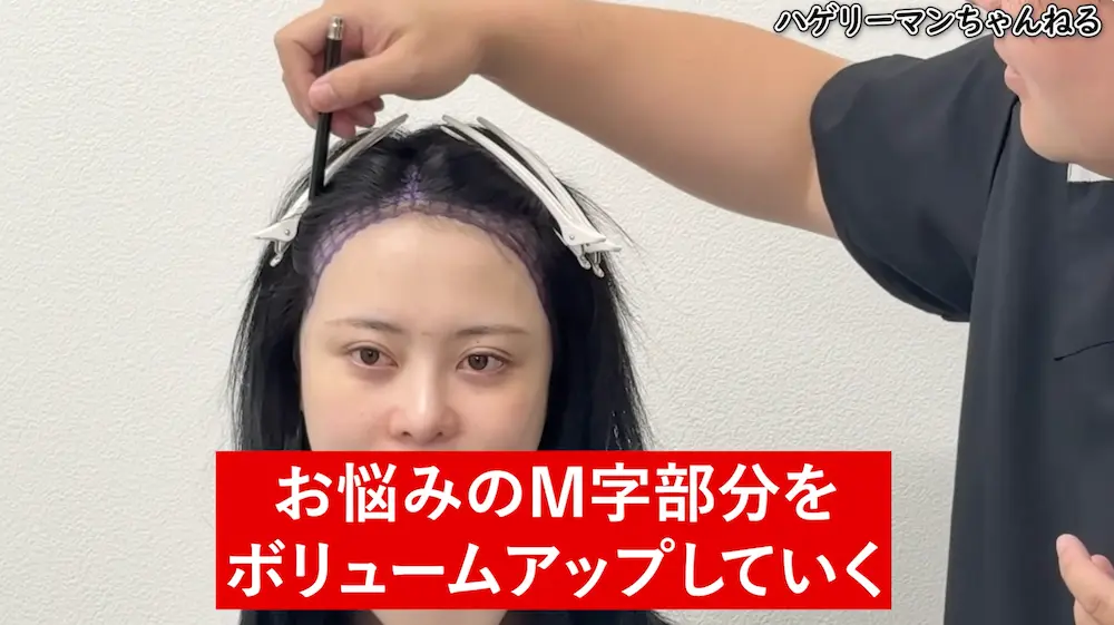 インフルエンサー「レイ」さんの植毛施術当日に密着｜美容植毛の