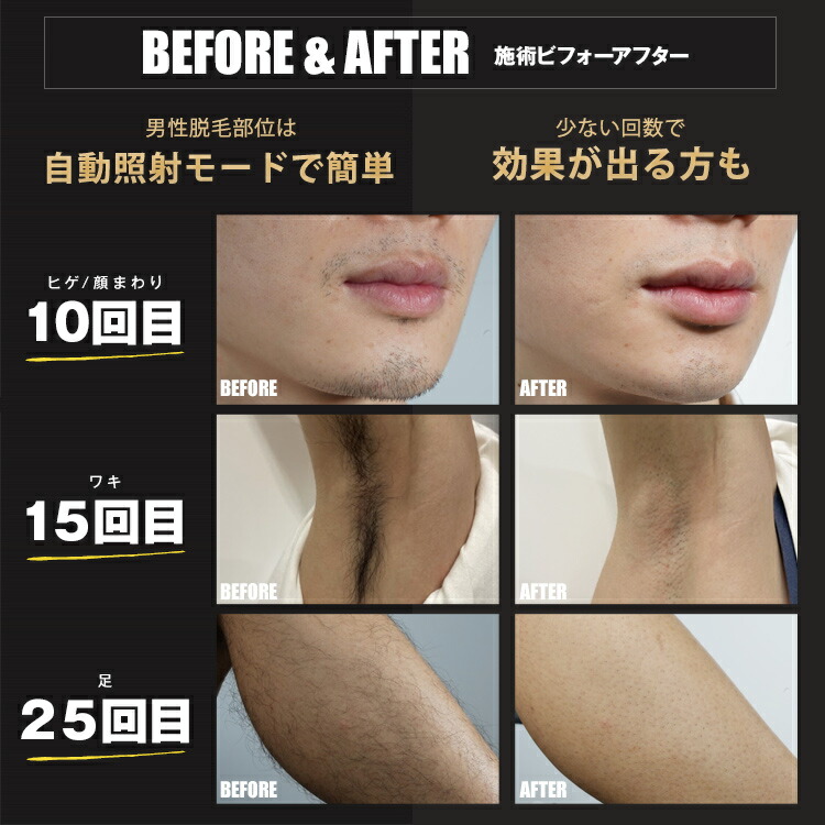 楽天市場】脱毛器 JOVS Dora2 SRモード A366 世界3冠 シリーズ265万台