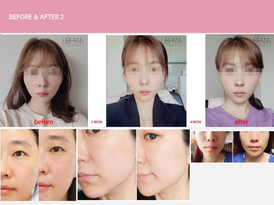 楽天市場】＼ポイント20倍／ エルフェイス ELFACE 美顔器 リフトアップ