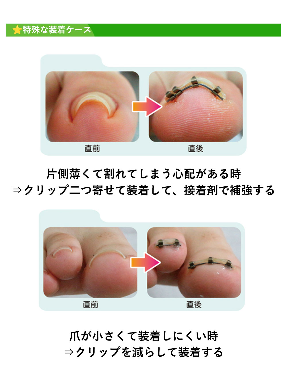 楽天市場】【ビデオあり・日本製！】巻き爪リフト 巻き爪 調整 正 巻爪