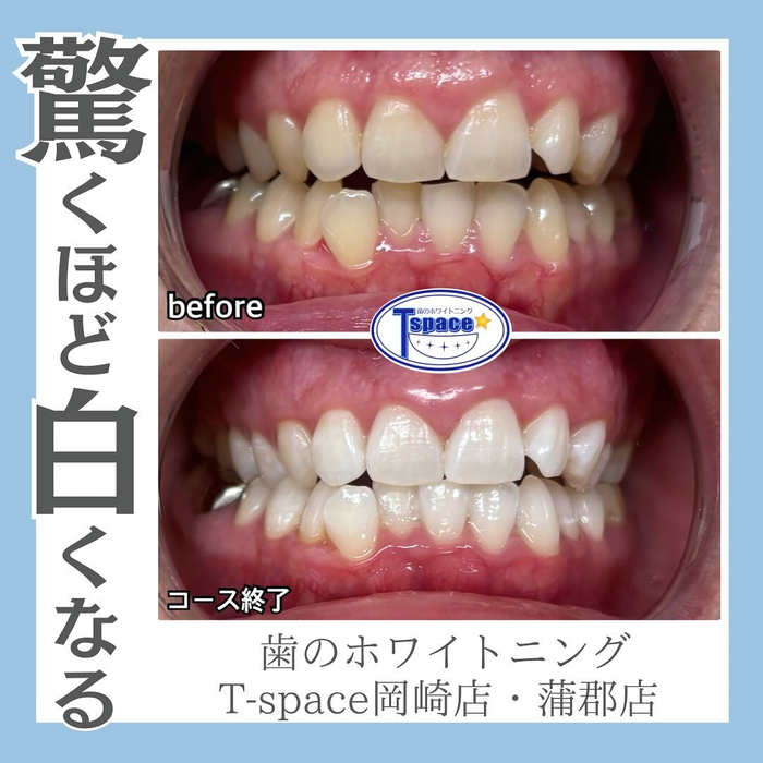 驚くほど白くなる！】 | Instagram | 愛知県蒲郡市のセルフ