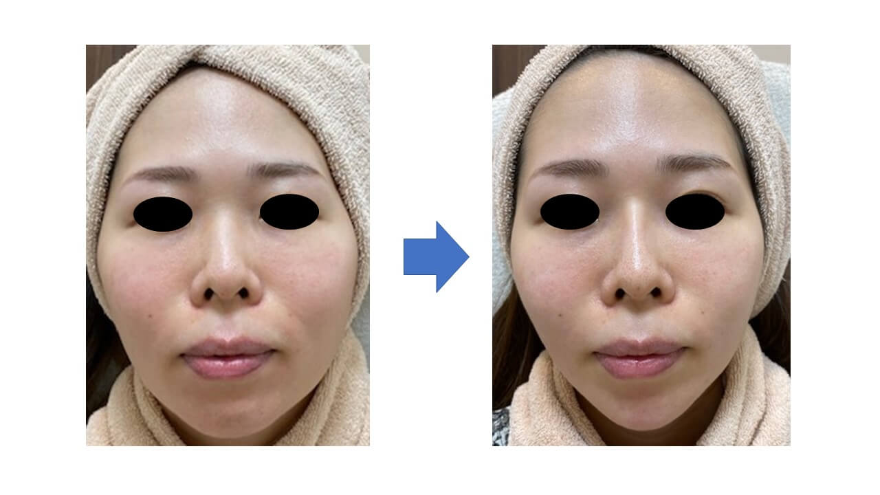 ヒアルロン酸注射 | 横浜の美容皮膚科 美容外科 アンジュール横浜