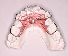 床矯正装置（拡大床、歯列の側方拡大に使用する矯正装置）｜アクイユ