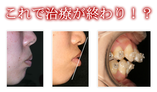 NGな矯正治療とは？（矯正失敗事例）｜伊賀市、桑名市のアイウエオ矯正