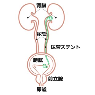 尿管ステントについて | 日本BD