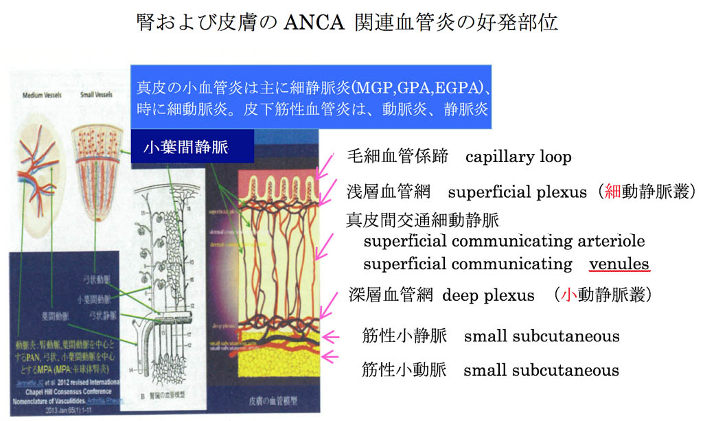 皮膚の血管炎の考え方2017 | 大阪大学医学部皮膚科学教室