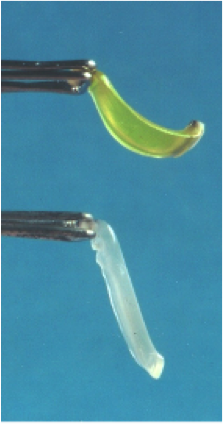 円錐角膜の治療 コラーゲン・クロスリンキング - 遠谷眼科｜白内障