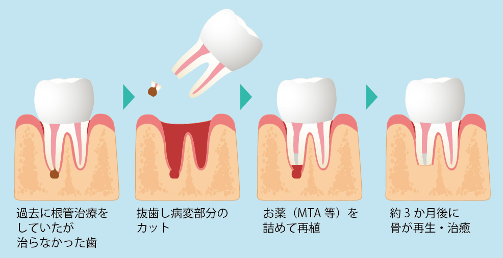 歯根端切除術・意図的再植術などの外科的歯内療法