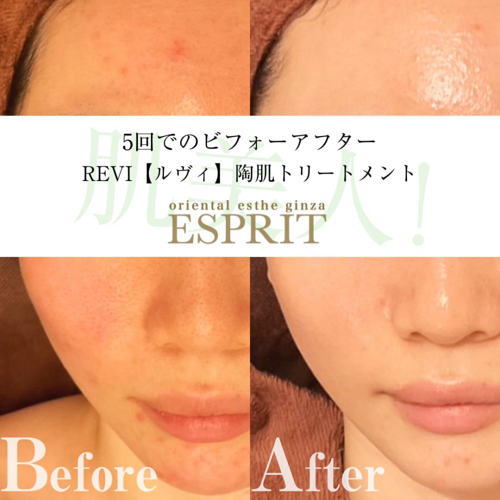 ハーブピーリングREVI【ルヴィ】陶肌トリートメント ｜東京銀座、新宿