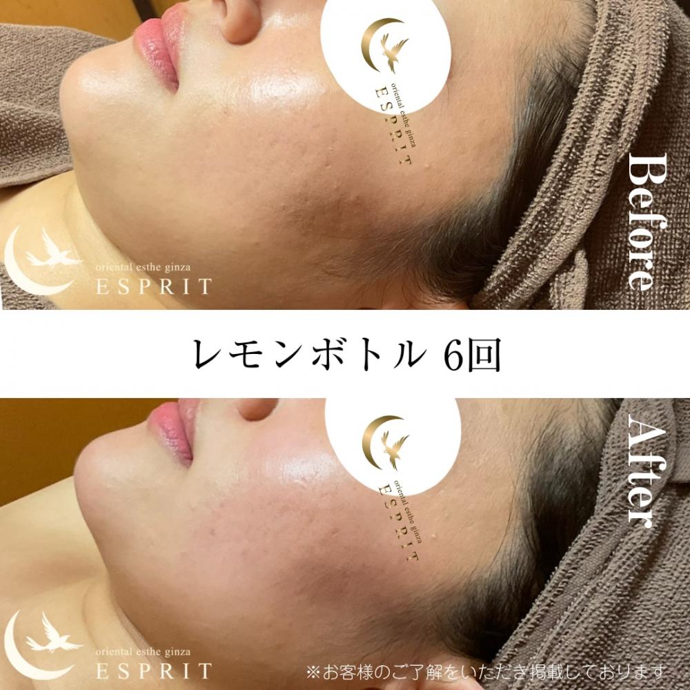 レモンボトル東京銀座新宿 ｜東京銀座、新宿のエステサロン 痩身＆肌