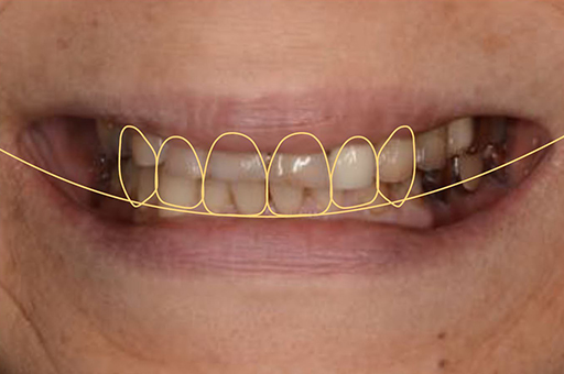 症例16 インプラント、ペリオ | 名古屋の歯周病専門医さぶり歯科