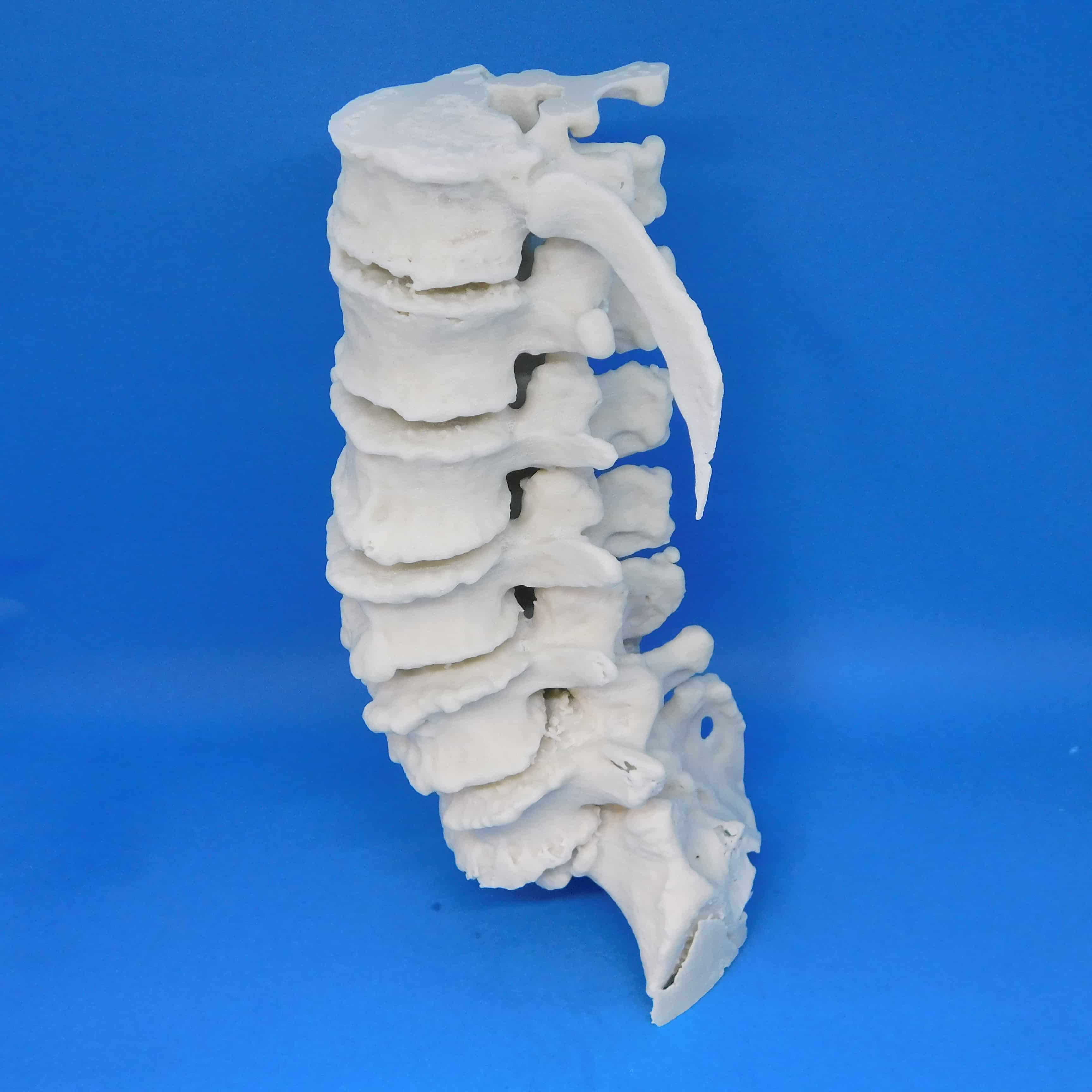 症例腰椎 F93の医療模型 | 3DモデルのKEZLEX