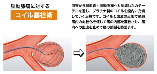 脳血管内治療～切らない治療～｜病気のはなし｜公立学校共済組合 関東