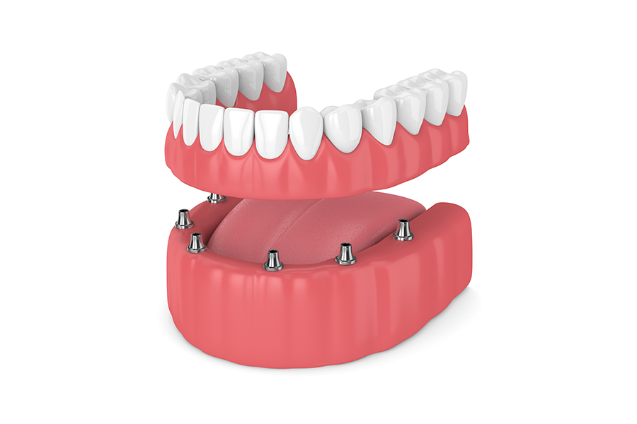 インプラントオーバーデンチャー - 菊川駅前歯科／高度歯科医療を実践