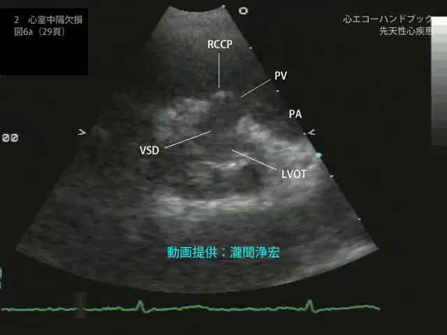 心エコーハンドブック 先天性心疾患｜付録動画｜見本サイト