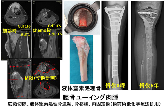 骨・軟部腫瘍紹介｜診療案内｜弘前大学大学院医学研究科 整形外科学講座