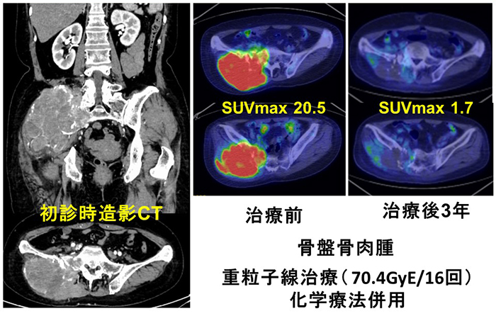 骨・軟部腫瘍紹介｜診療案内｜弘前大学大学院医学研究科 整形外科学講座