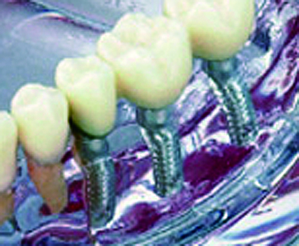 患者説明用インプラント模型｜株式会社インプラテックスの取扱い商品