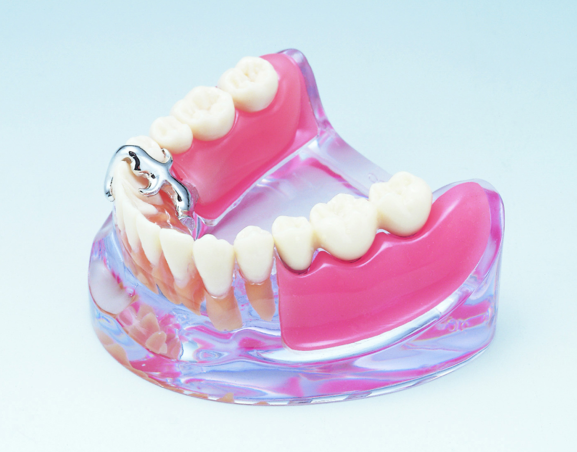 患者説明用インプラント模型｜株式会社インプラテックスの取扱い商品