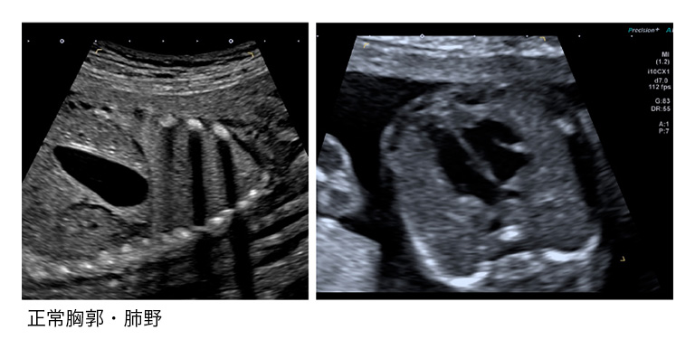 20. 胎児の形態異常（胸部） – 日本産婦人科医会